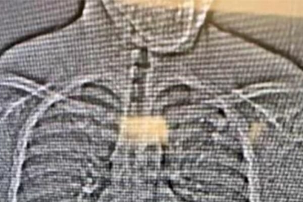 Detectives recover 4 diamond earrings weeks after the suspect swallowed them in the middle of arrest