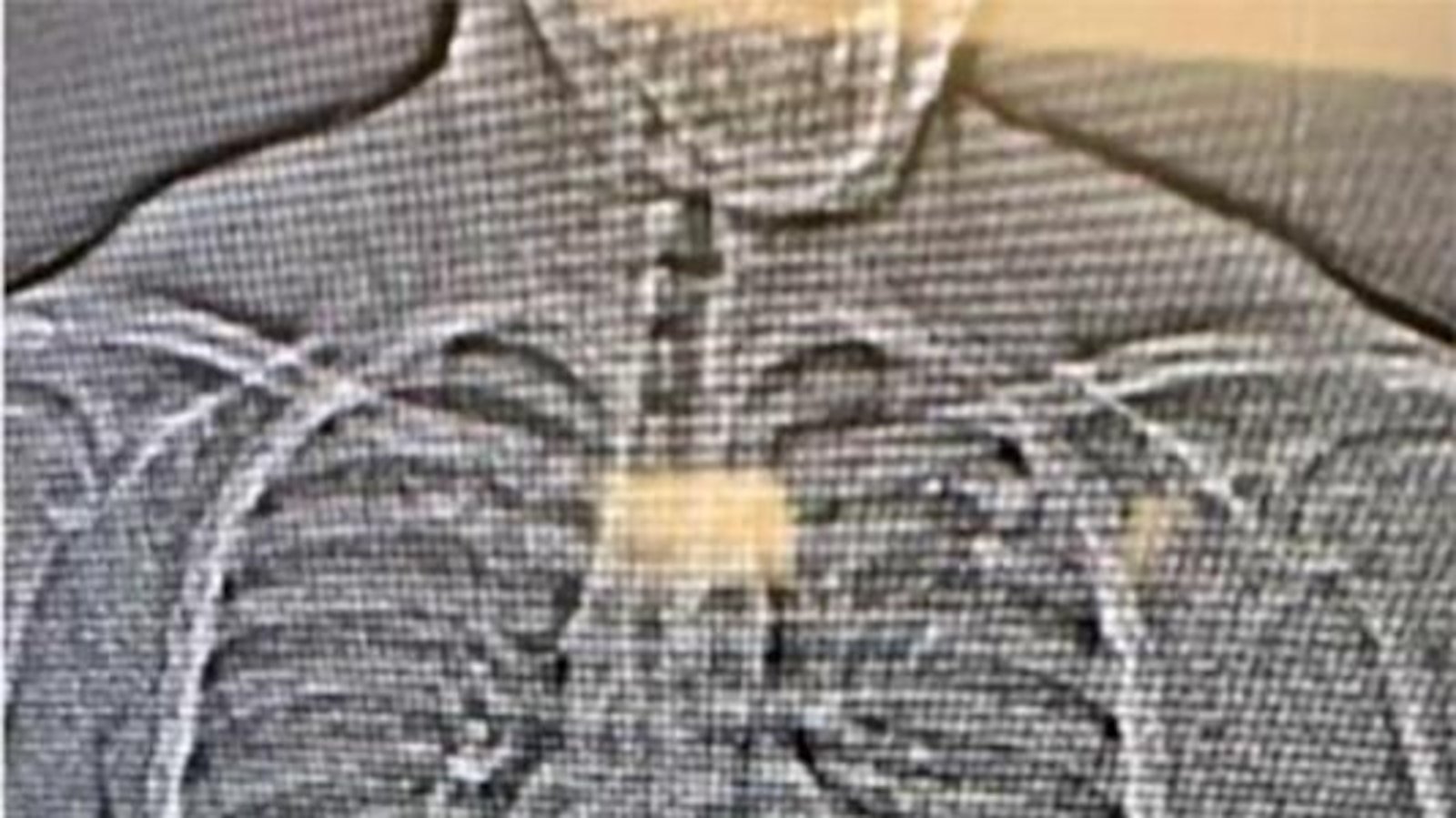 Detectives recover 4 diamond earrings weeks after the suspect swallowed them in the middle of arrest