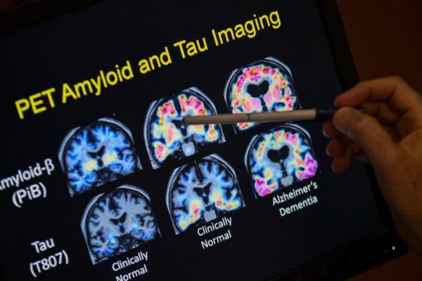 The FDA is fine, first blood analysis that can help diagnose Alzheimer's disease