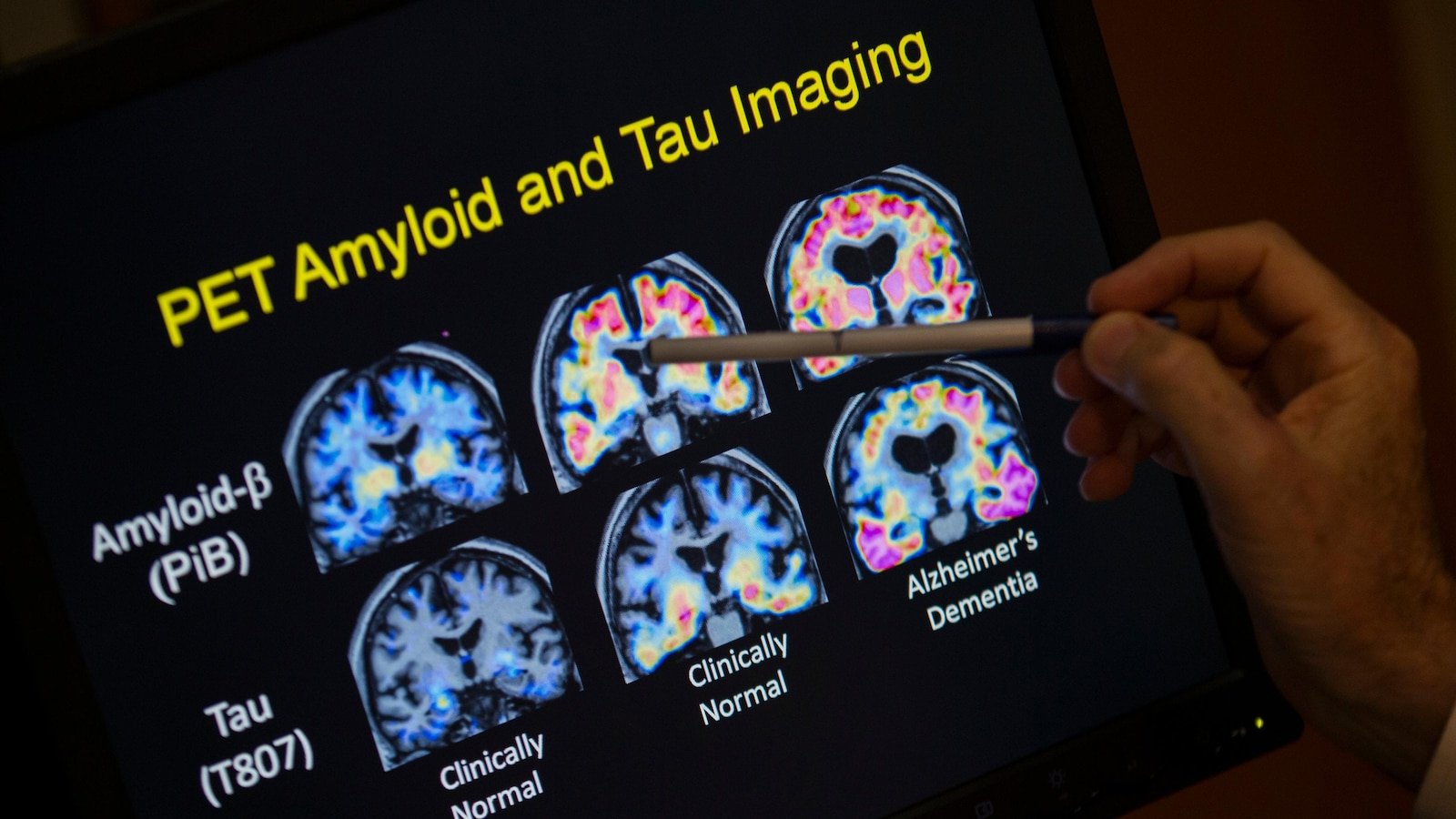 The FDA is fine, first blood analysis that can help diagnose Alzheimer's disease